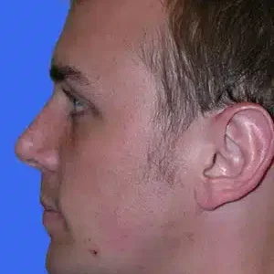 Chin Augmentation before and after photos