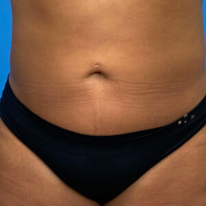 Liposuction before and after photos