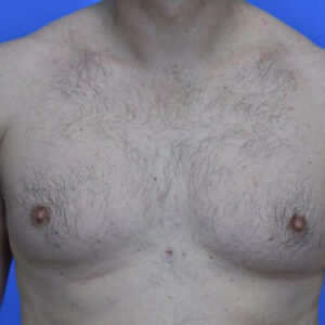 Male Breast Reduction before and after photos