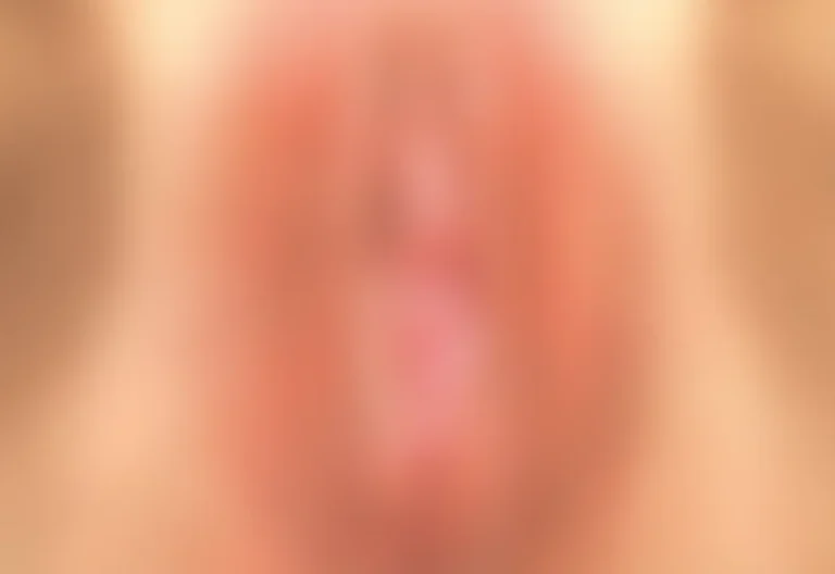 ThermiVa: Before and After Gallery