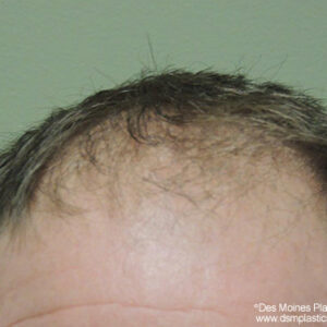 Neograft Hair Loss Replacement before and after photos