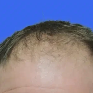 Neograft Hair Loss Replacement before and after photos