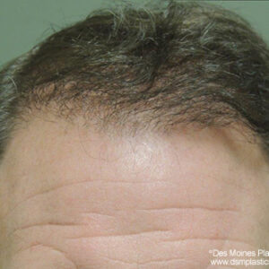 Neograft Hair Loss Replacement before and after photos