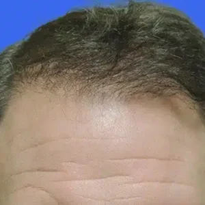 Neograft Hair Loss Replacement before and after photos