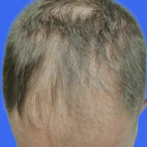Neograft Hair Loss Replacement before and after photos