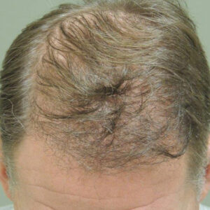 Neograft Hair Loss Replacement before and after photos