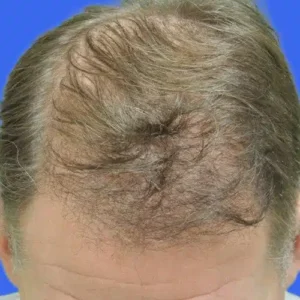 Neograft Hair Loss Replacement before and after photos