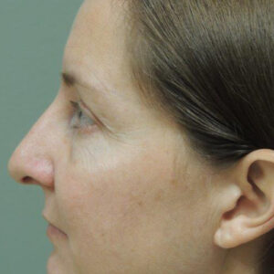 Rhinoplasty before and after photos