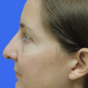 Rhinoplasty before and after photos