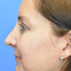 Rhinoplasty before and after photos