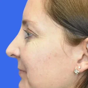 Rhinoplasty before and after photos