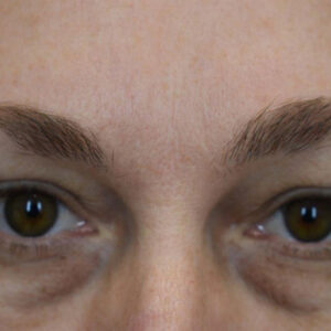 Eyelid Surgery before and after photos