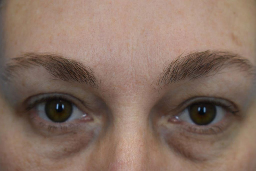 Eyelid Surgery before and after photos