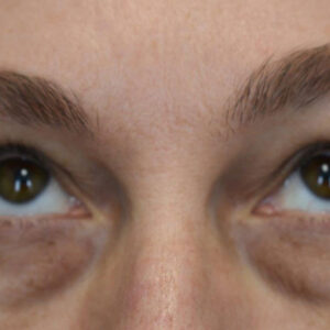 Eyelid Surgery before and after photos