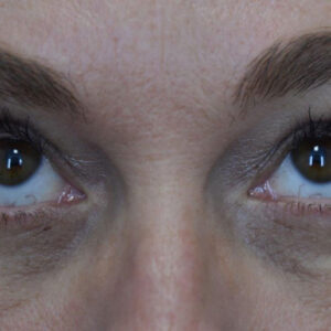 Eyelid Surgery before and after photos