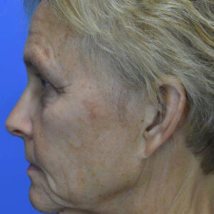 Face Lift before and after photos