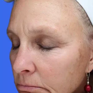 Laser Skin Resurfacing before and after photos