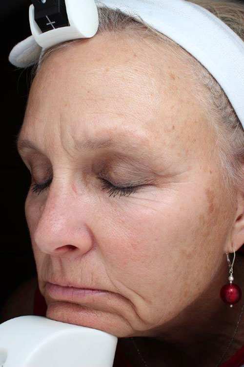 Laser Skin Resurfacing before and after photos
