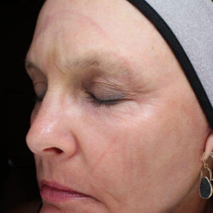 Laser Skin Resurfacing before and after photos