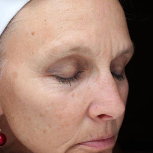 Laser Skin Resurfacing before and after photos