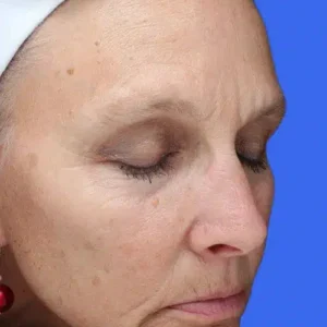 Laser Skin Resurfacing before and after photos