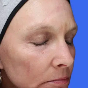 Laser Skin Resurfacing before and after photos