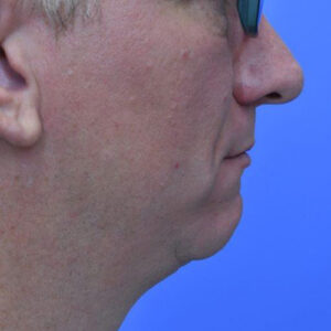Laser Lift before and after photos