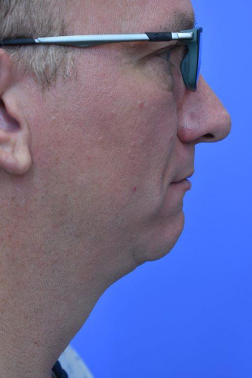 Laser Lift before and after photos
