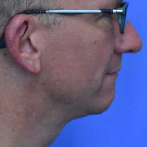 Laser Lift before and after photos