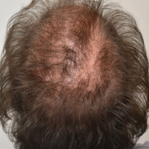 PRP Hair Loss Replacement before and after photos
