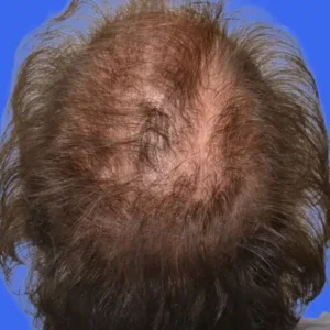 PRP Hair Loss Replacement before and after photos