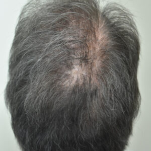 PRP Hair Loss Replacement before and after photos