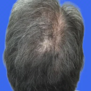 PRP Hair Loss Replacement before and after photos