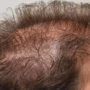 PRP Hair Loss Replacement before and after photos