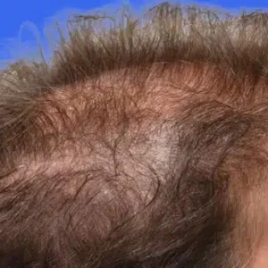 PRP Hair Loss Replacement before and after photos