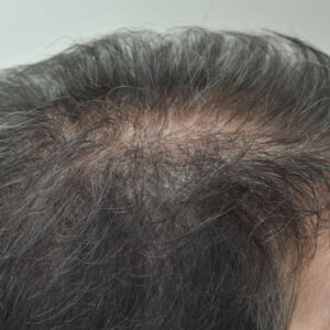 PRP Hair Loss Replacement before and after photos