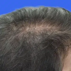 PRP Hair Loss Replacement before and after photos