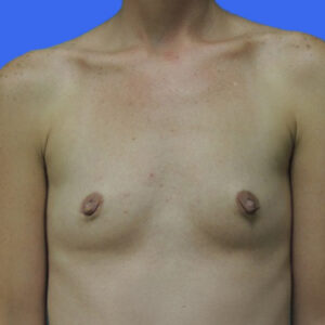 Breast Augmentation Before Photo by Des Moines Plastic Surgery