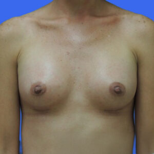 Breast Augmentation Before Photo by Des Moines Plastic Surgery