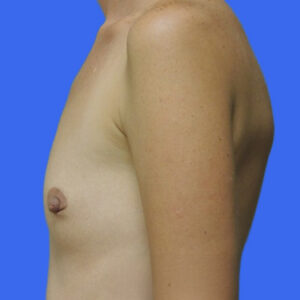 Breast Augmentation Before Photo by Des Moines Plastic Surgery