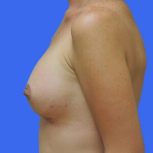 Breast Augmentation Before Photo by Des Moines Plastic Surgery