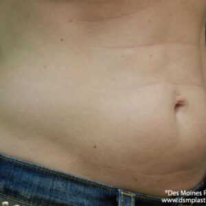 CoolSculpting before and after photos