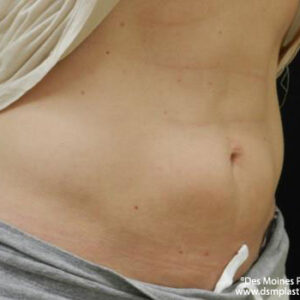 CoolSculpting before and after photos