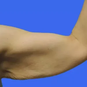 Arm Lift