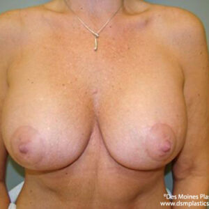 Breast Lift with Augmentation before and after photos