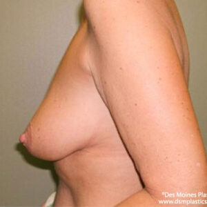 Breast Lift with Augmentation before and after photos