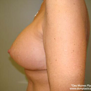 Breast Lift with Augmentation before and after photos