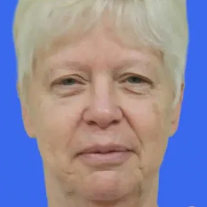 Face Lift before and after photos