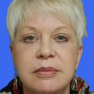 Face Lift before and after photos