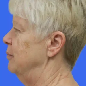 Face Lift before and after photos